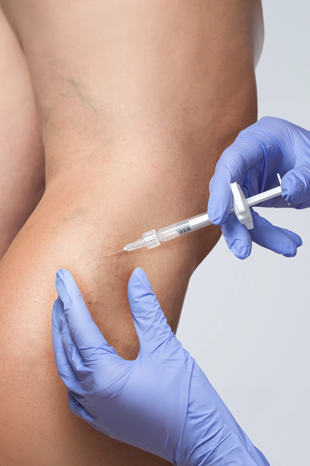 Escleroterapia Líquida