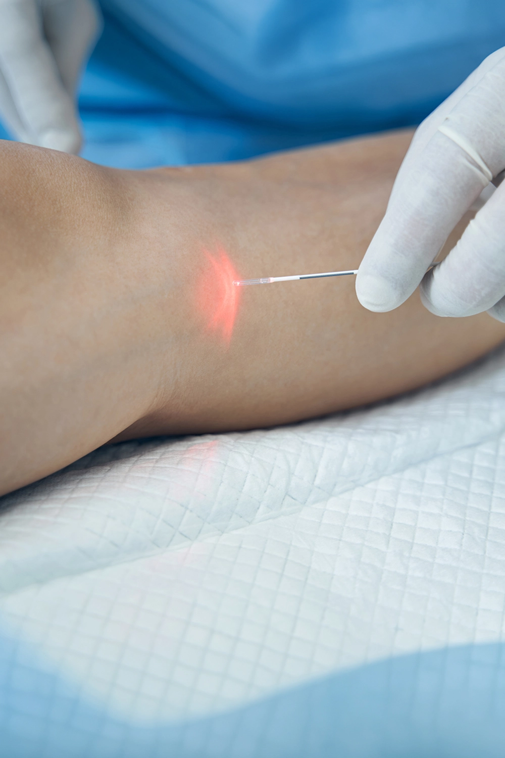Laser Endovenoso