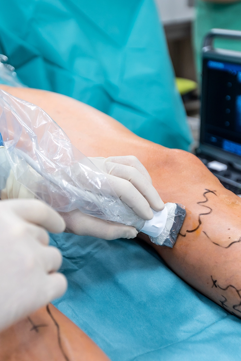 Microcirurgia de Varizes